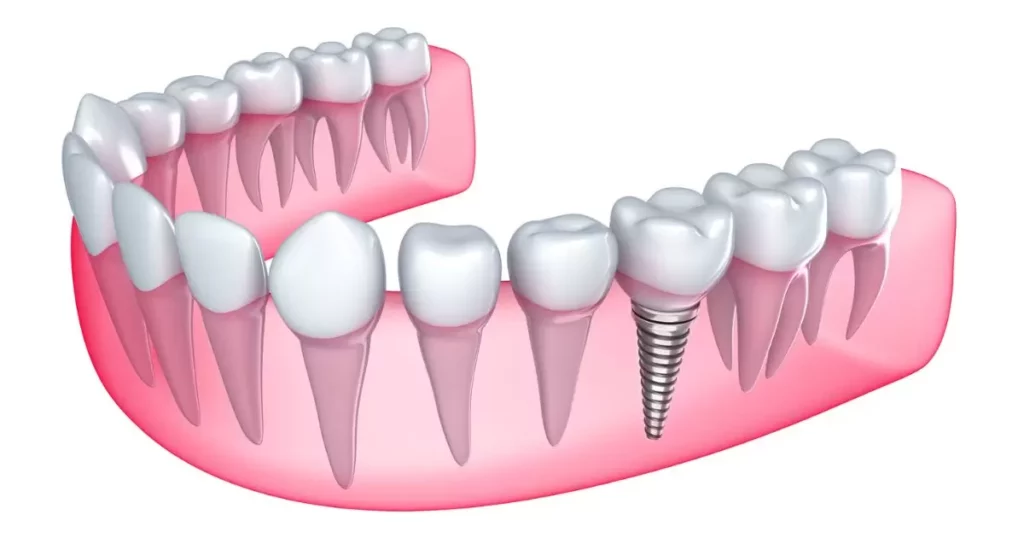 Alternative Options to Dentures and Partials