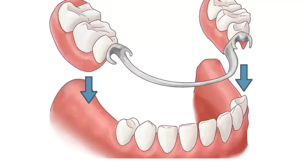 Alternatives to Partial Dentures