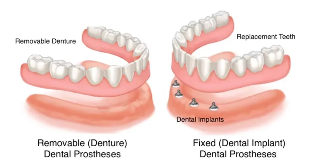 Challenges in Denture-Induced Bone Loss