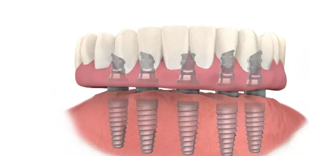 Cost Of Implant-Supported Dentures At Aspen Dental