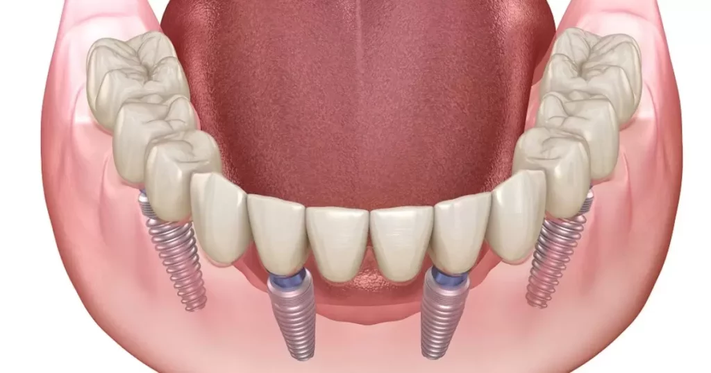 Dental implants for denture wearers