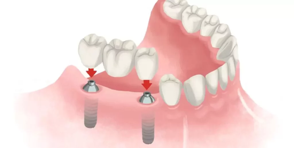 Dentures Vs Veneers Vs Implants