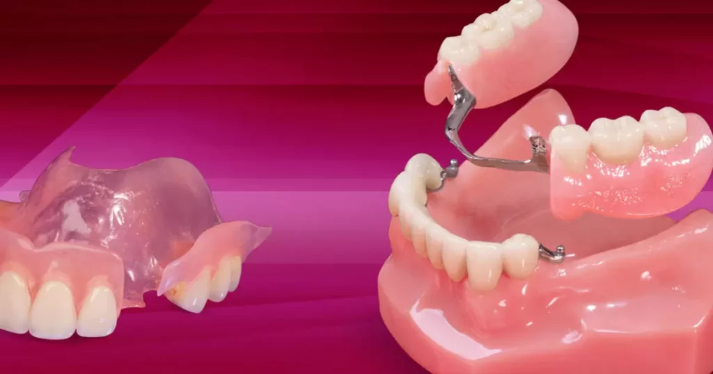 Future Developments in Partial Dentures