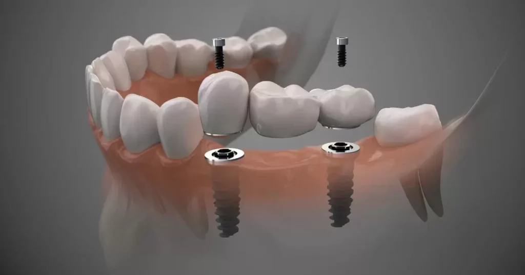  Future Trends in Dental Prosthetics