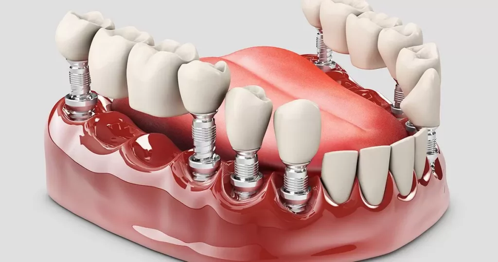 Future Trends in Denture Technology