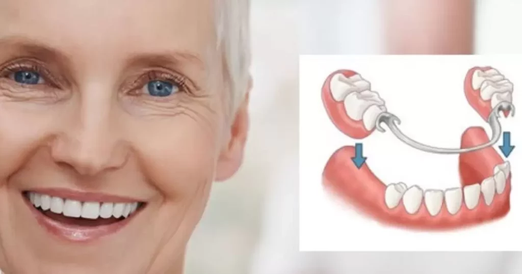 How are permanent dentures installed