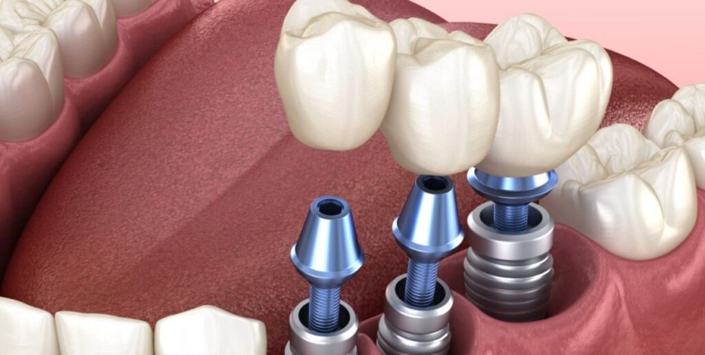 Stages of All-on-4 implant treatment