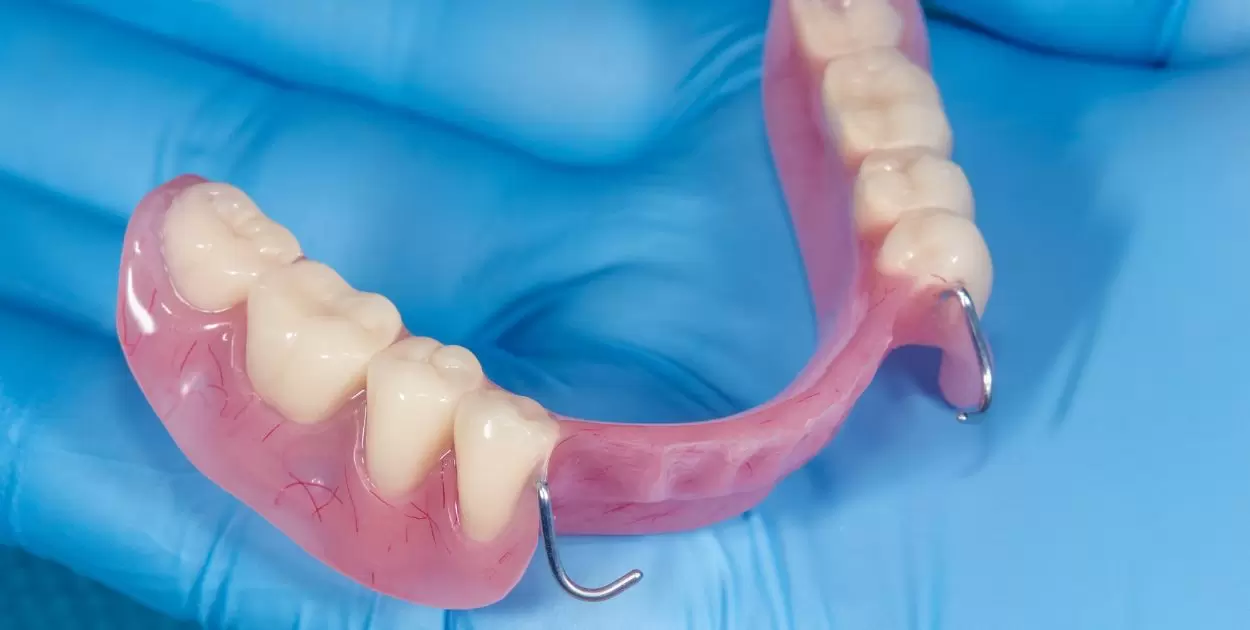 How Does A Single Tooth Denture Stay In?
