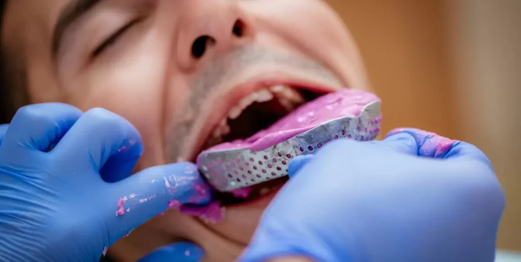 How Long Does It Take To Make Dentures After Impressions