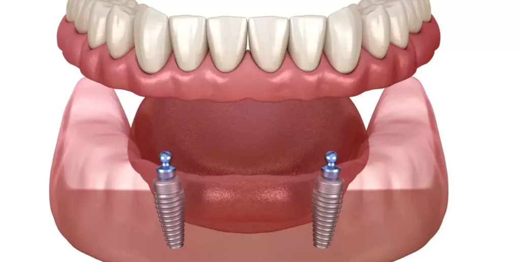 How Much Do Implant-supported Dentures Cost?