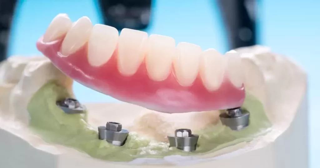 How Much Do Snap-In Denture Implants Cost