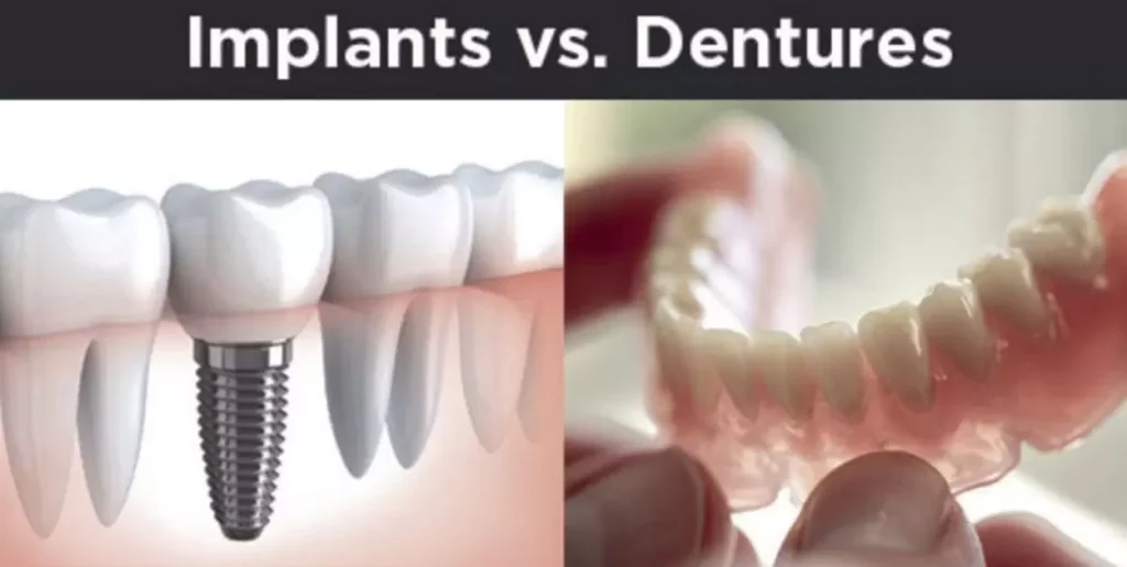 Hybrid Dentures Vs Implants