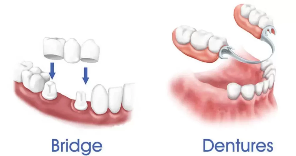 Key Differences Between Dentures and Partials
