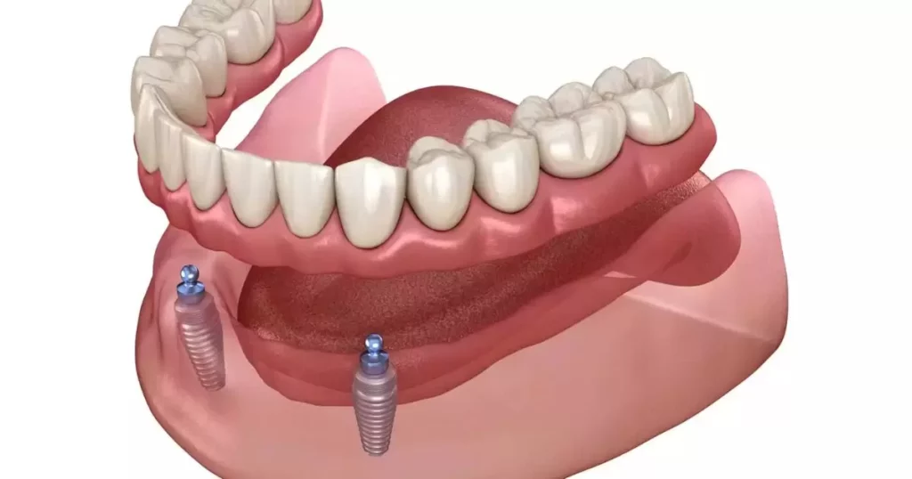 Snap in dentures vs implants