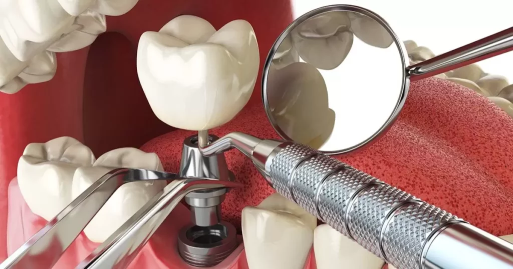 The Fundamentals of Dental Implants