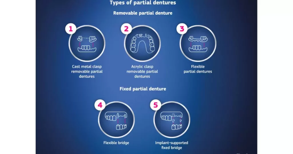 Type Of Partial Dentures