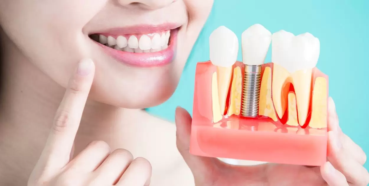 What Is A Hybrid Implant Denture?