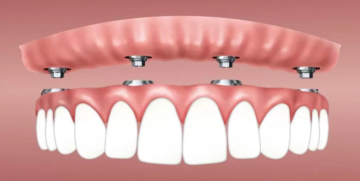 What Is All On 4 Dentures?