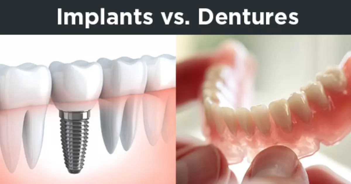 What Is The Difference Between Implants And Dentures?