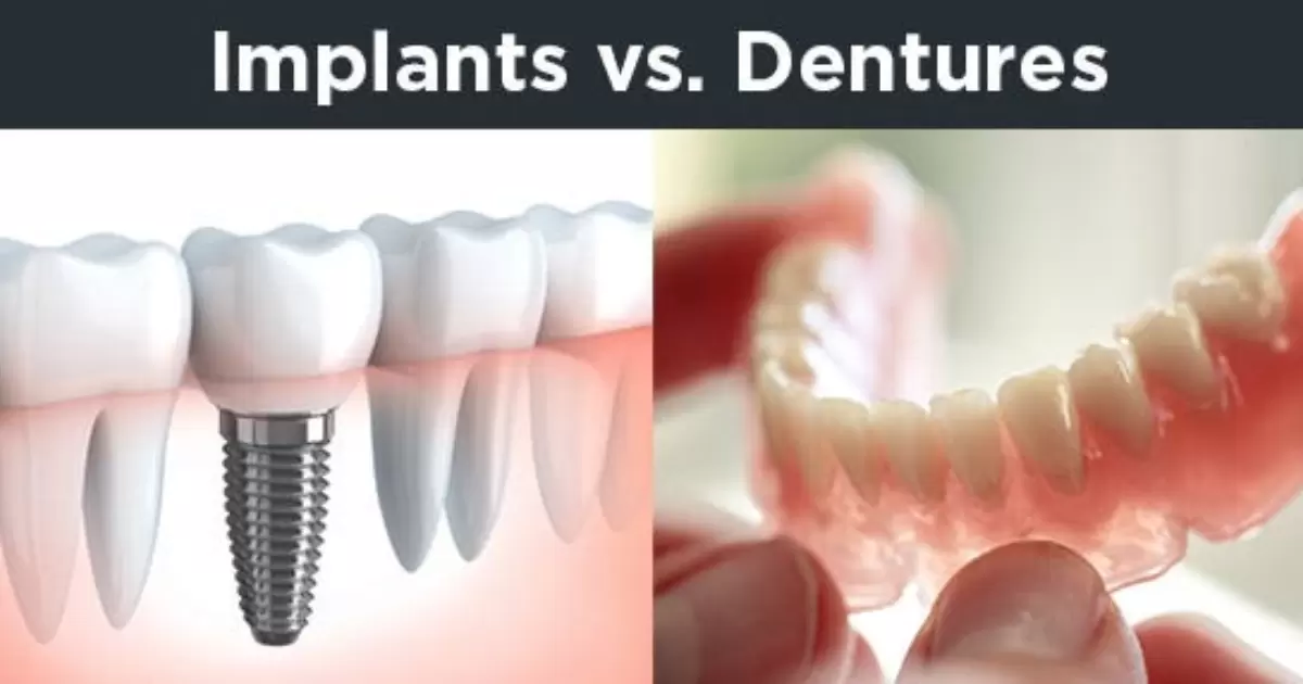 What Is The Difference Between Permanent Dentures And Implants?