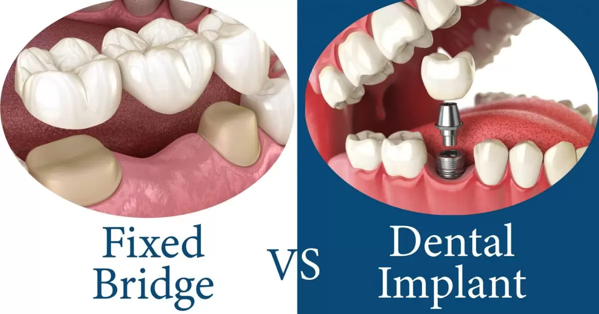 What's The Difference Between Dental Implants And Dentures?