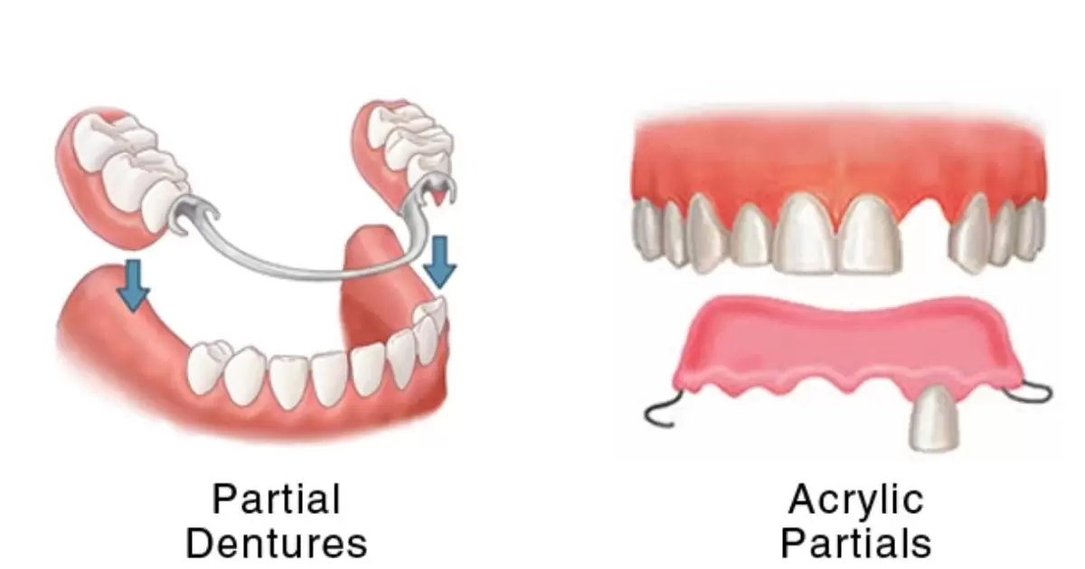 What's The Difference Between Dentures And Partials?