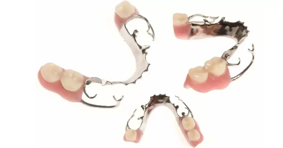 Which Is Better Partial Denture Or Bridge?