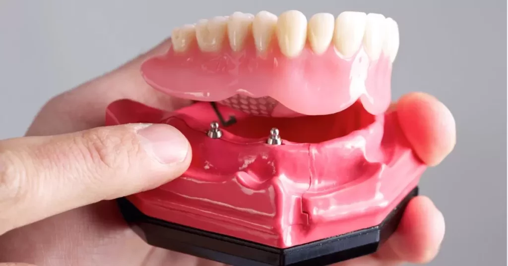 Which is right for me: implants or dentures?