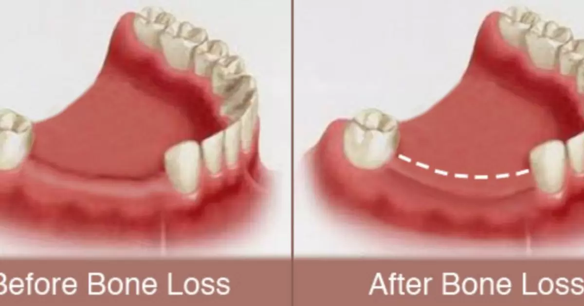 Will Dentures Prevent Bone Loss?