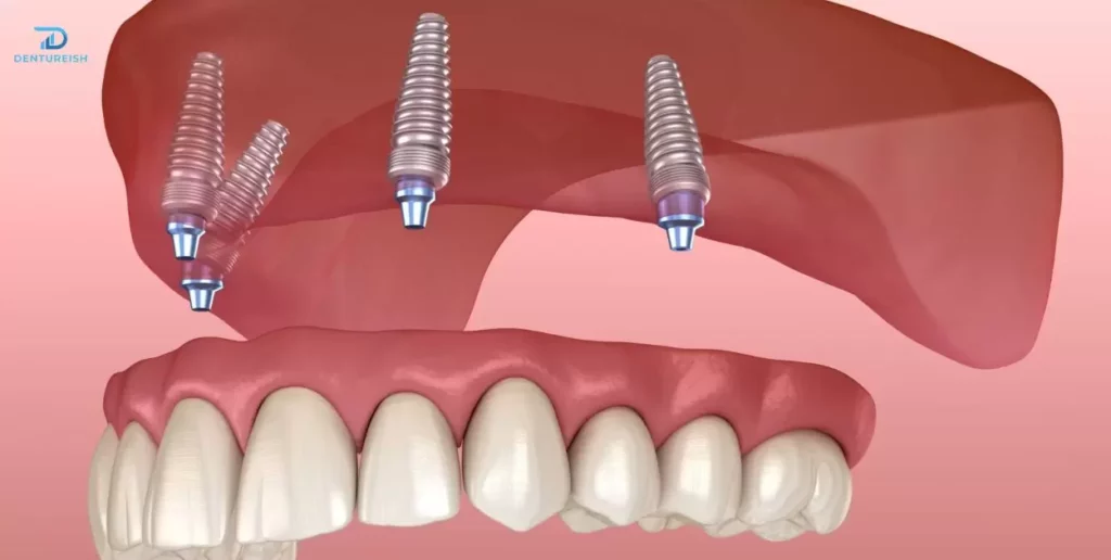 Addressing Damaged or Defective Dentures