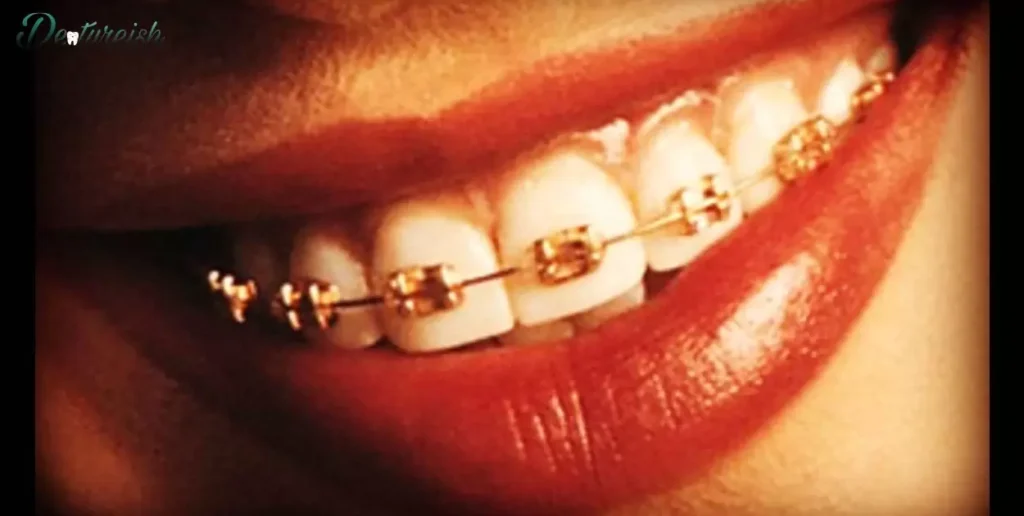 Are Gold Teeth Dentures Safe?