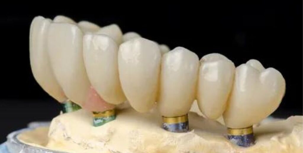 Are Implant-Supported Dentures a Treatment Possibility?