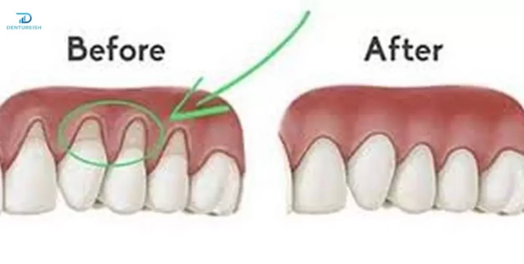 Can Dentures Be Fitted To Receding Gums