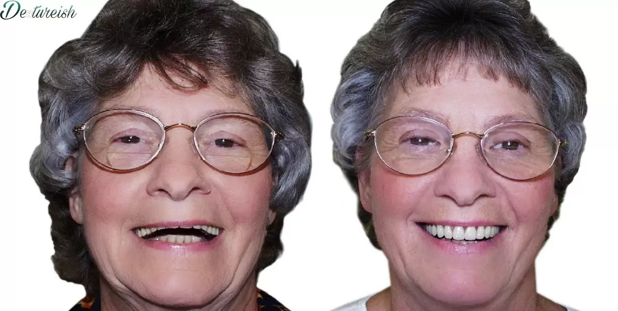 Can Partial Dentures Be Permanent?