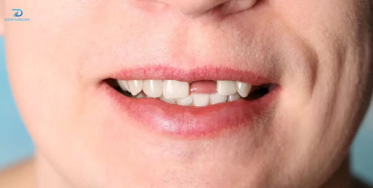 Can Regular Dentures Be Permanently Attached?