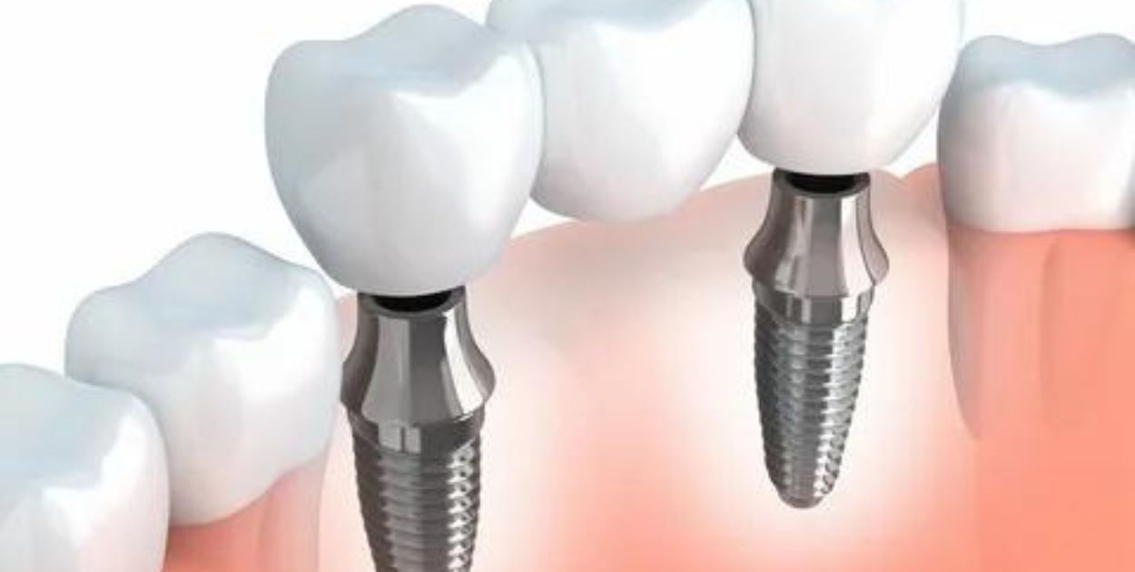 Can You Get Dental Implants After Having Dentures?