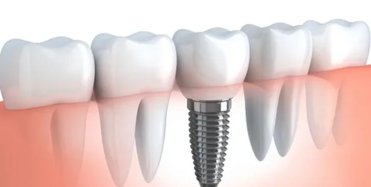 Can You Get Dental Implants After Wearing Dentures?
