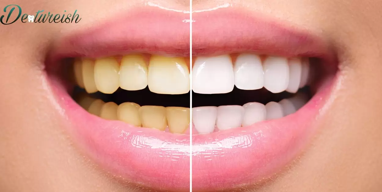 Can You Get Veneers Instead Of Dentures?