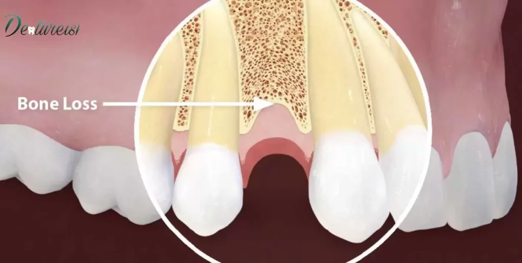 Dental Implants and Bone Loss Connection