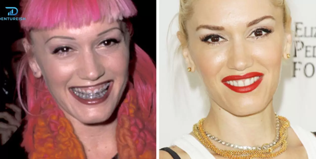 Does Gwen Stefani Have Dentures?