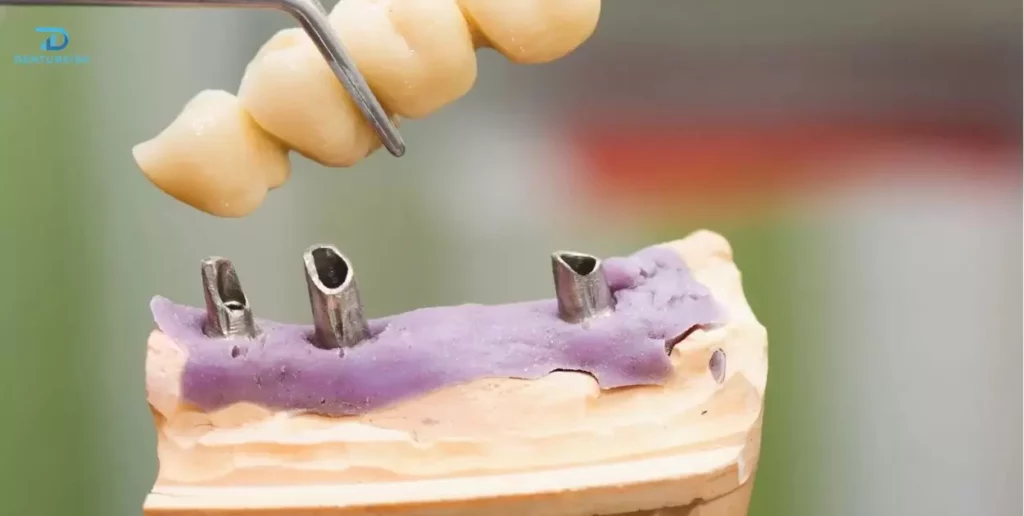Exploring Implant-Supported Dentures for Stability