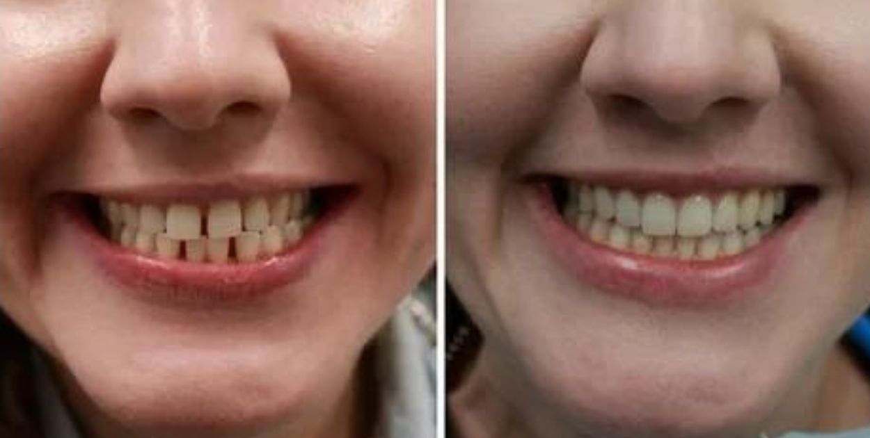 Will Getting Dentures Stop Gum Disease?