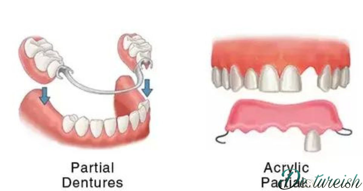 How Long Do Partial Dentures Last?