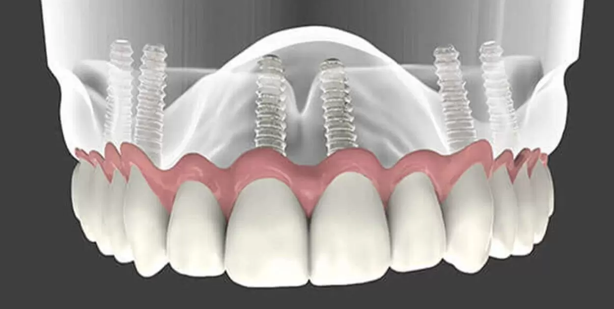 How Much Are Implant Supported Dentures?