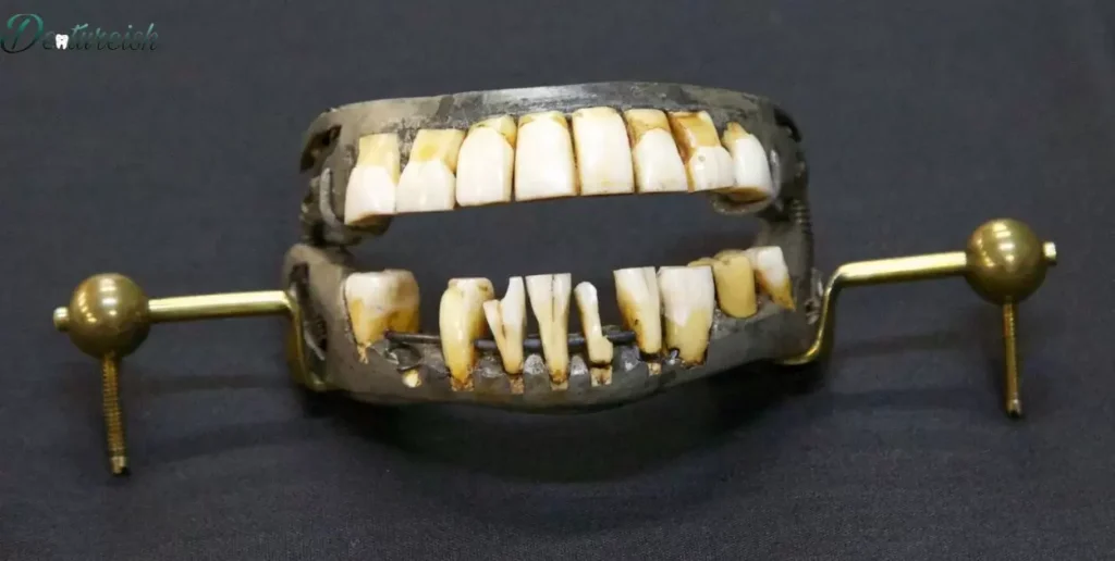 How To Put Gold On Dentures