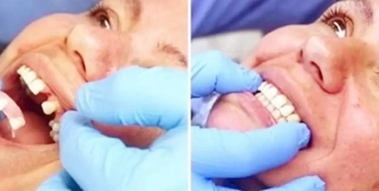 Is Alveoloplasty Necessary For Dentures?