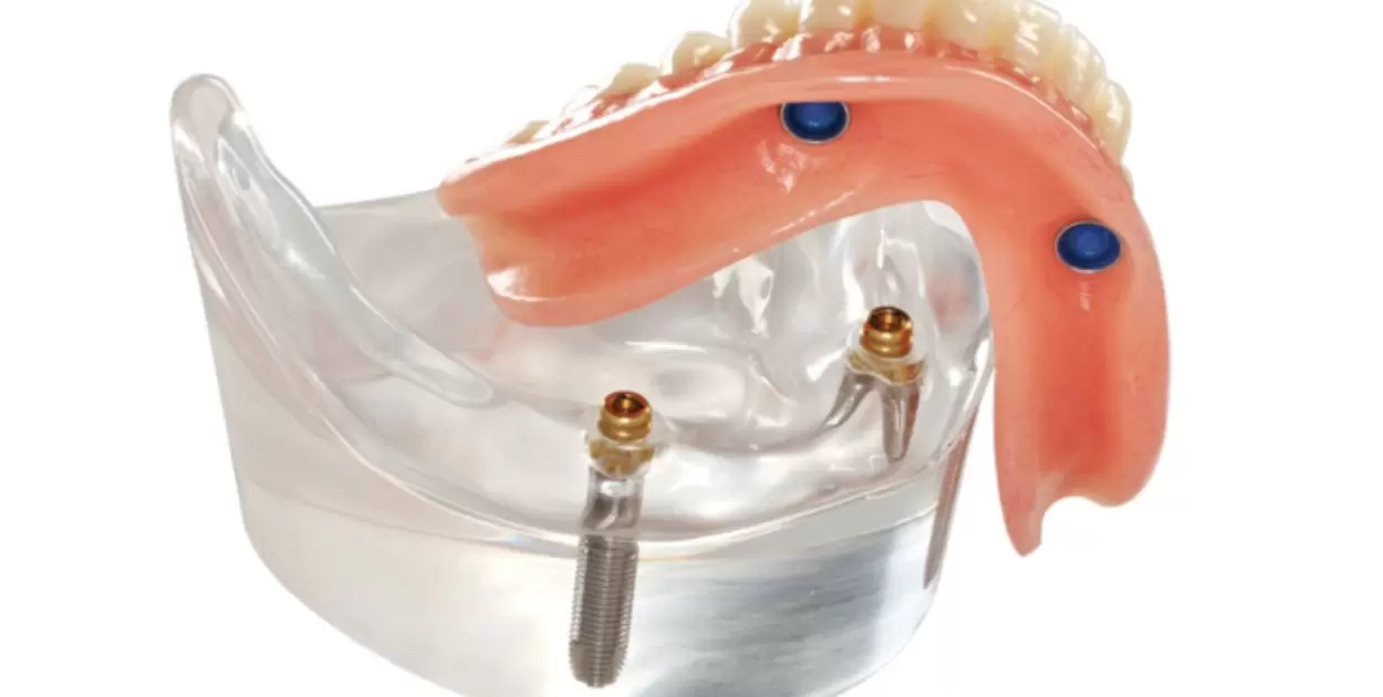 No Suction On Top Denture?