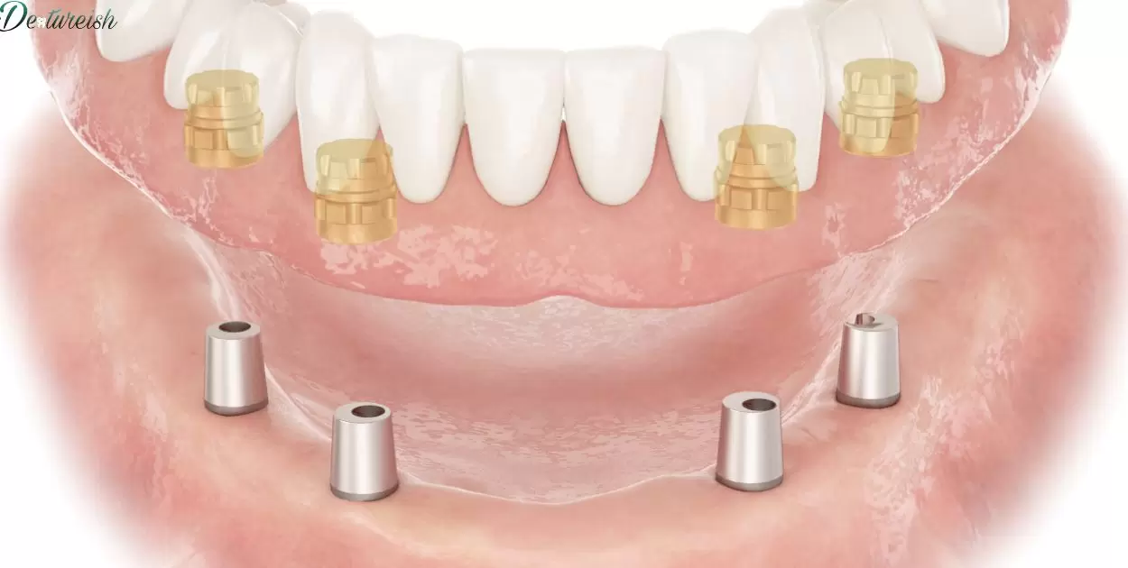 Partial Dentures For Upper Back Teeth?