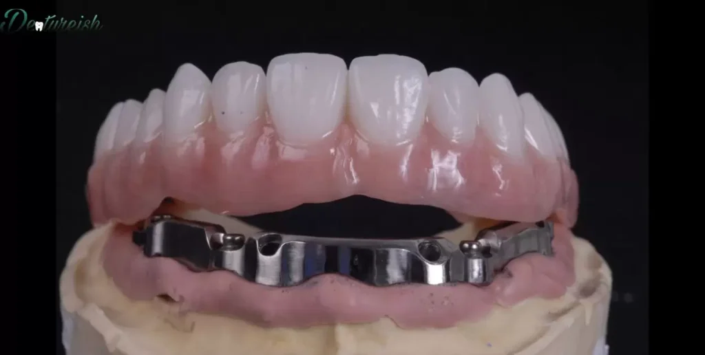 The Denture Placement Process Explained