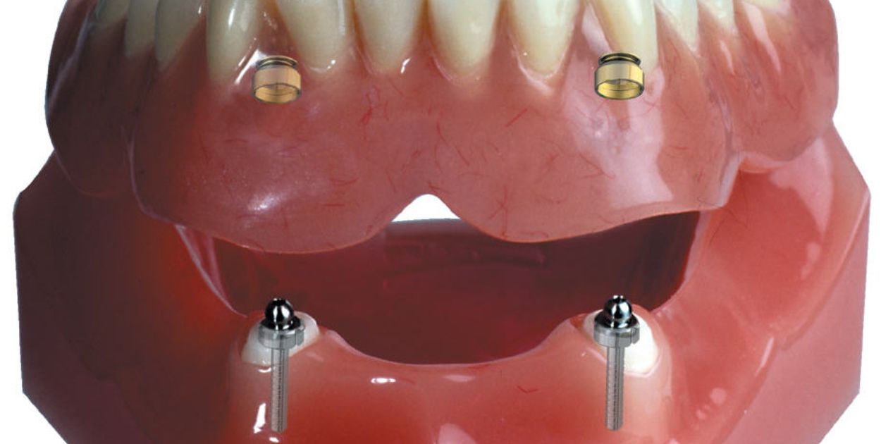 What Does Per Arch Mean For Dentures?